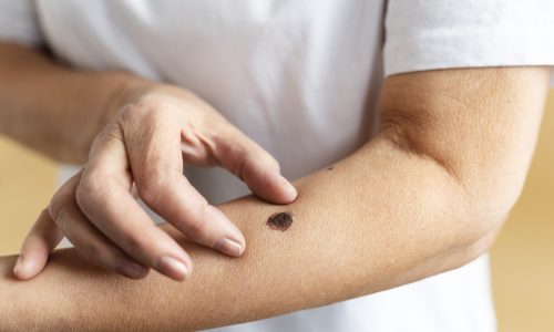 high-angle-hand-measuring-mole