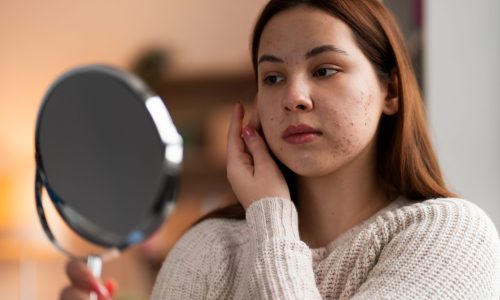 person-dealing-with-rosacea