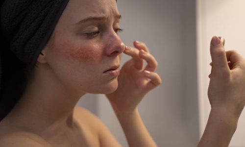 woman-looking-her-rosacea-mirror